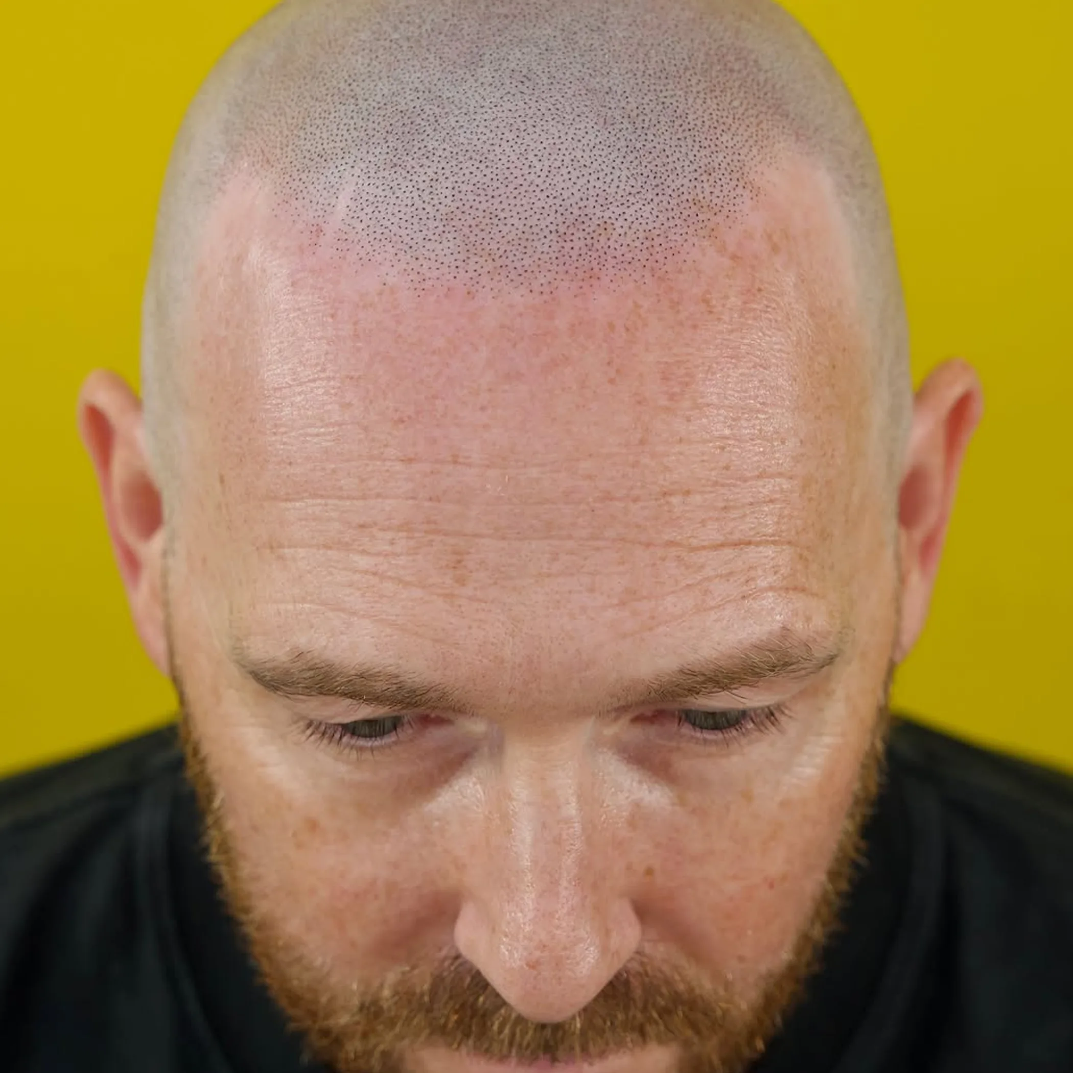 scalp micropigmentation coverage aftercare